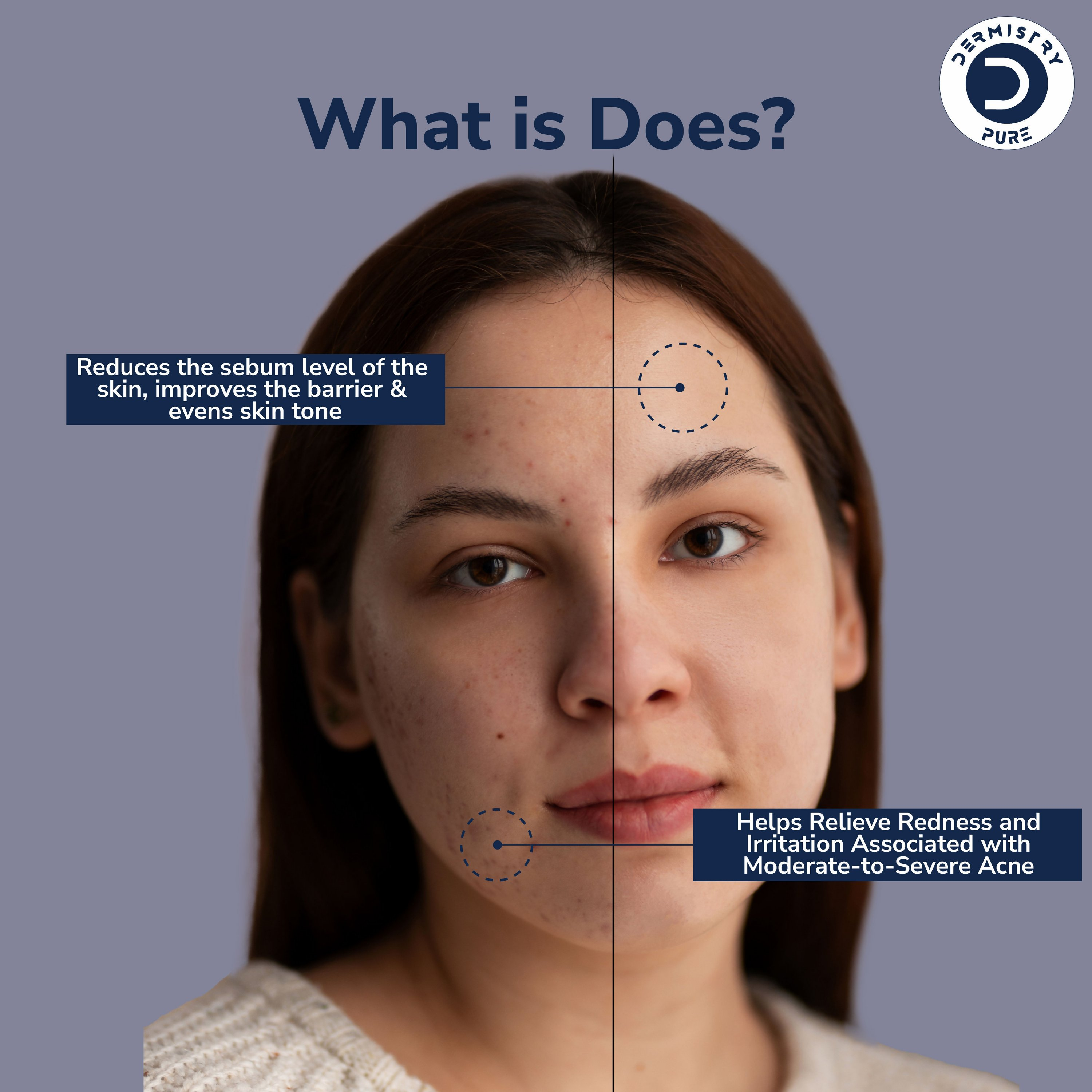 Dermistry 12% Niacinamide 2% Zinc Face Serum For Oil Blemish Control Minimize Pores & Even Skin Tone