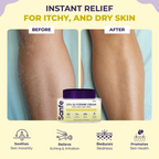 Sanfe Eczema Relief Cream For Very Very Dry Skin