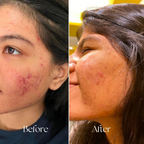 BiE Calm Your Zits Anti Acne Gel