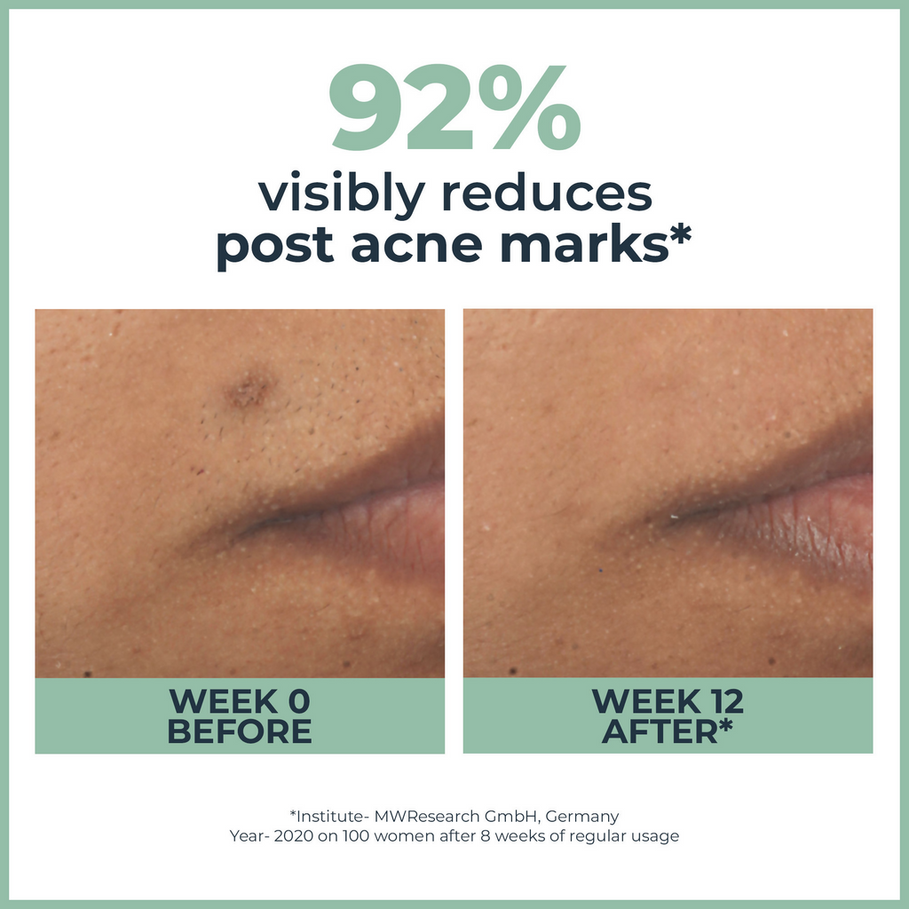 Eucerin Dermopurifyer Toner Cleansing Gel & Serum Combo