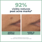 Eucerin Dermopurifyer Toner Cleansing Gel & Serum Combo