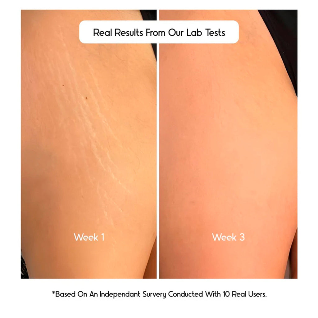 Cos-IQ Stretch Marks Removal Roll-On Serum with Striover