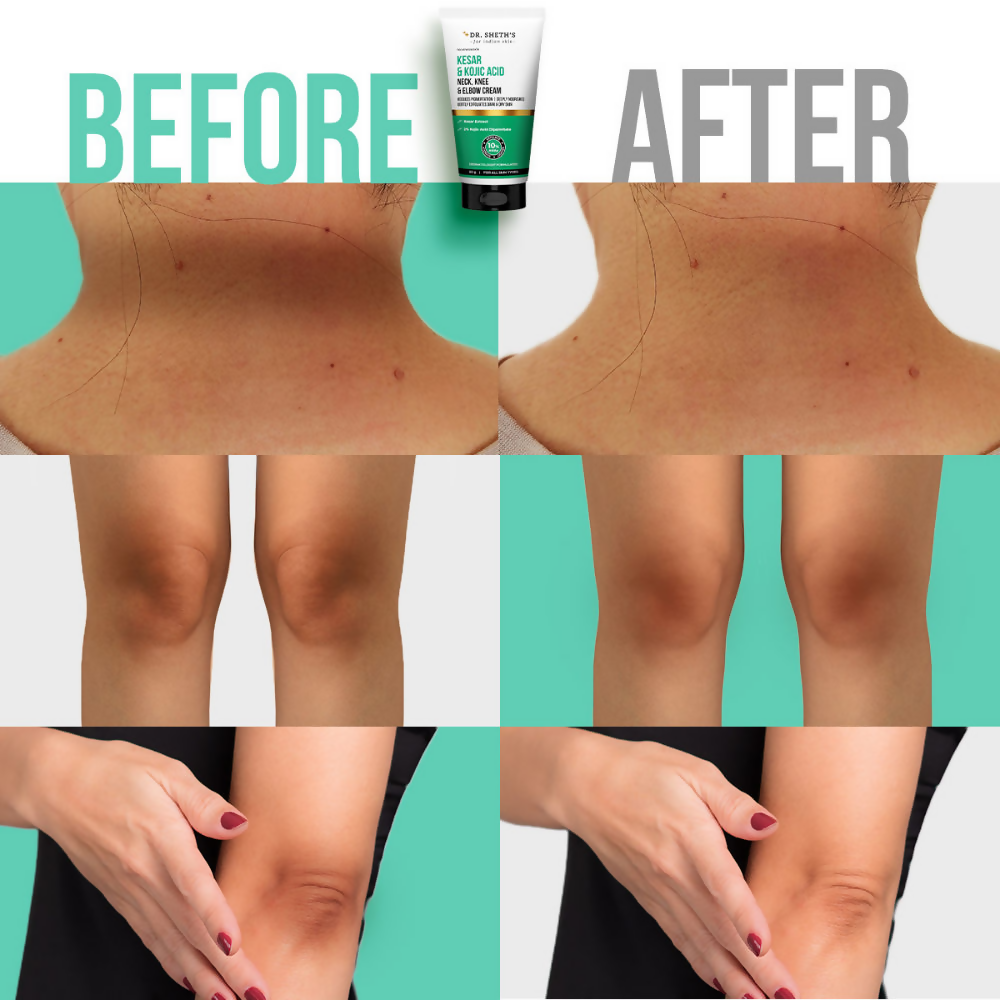 Dr. Sheth's Kesar & Kojic Acid Neck Knee & Elbow Cream