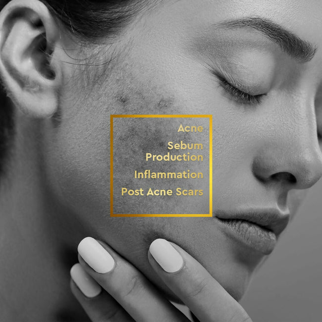 VLCC Clinic Acne Control Regime CSMS (Cleanser, Serum, Moisturizer, Sunscreen) For Acne Care Combo Main Image