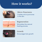 Man Matters Derma Roller 1.00 mm With 540 Titanium Alloy Needles - Promotes Beard Growth & Reduces Acne Scars