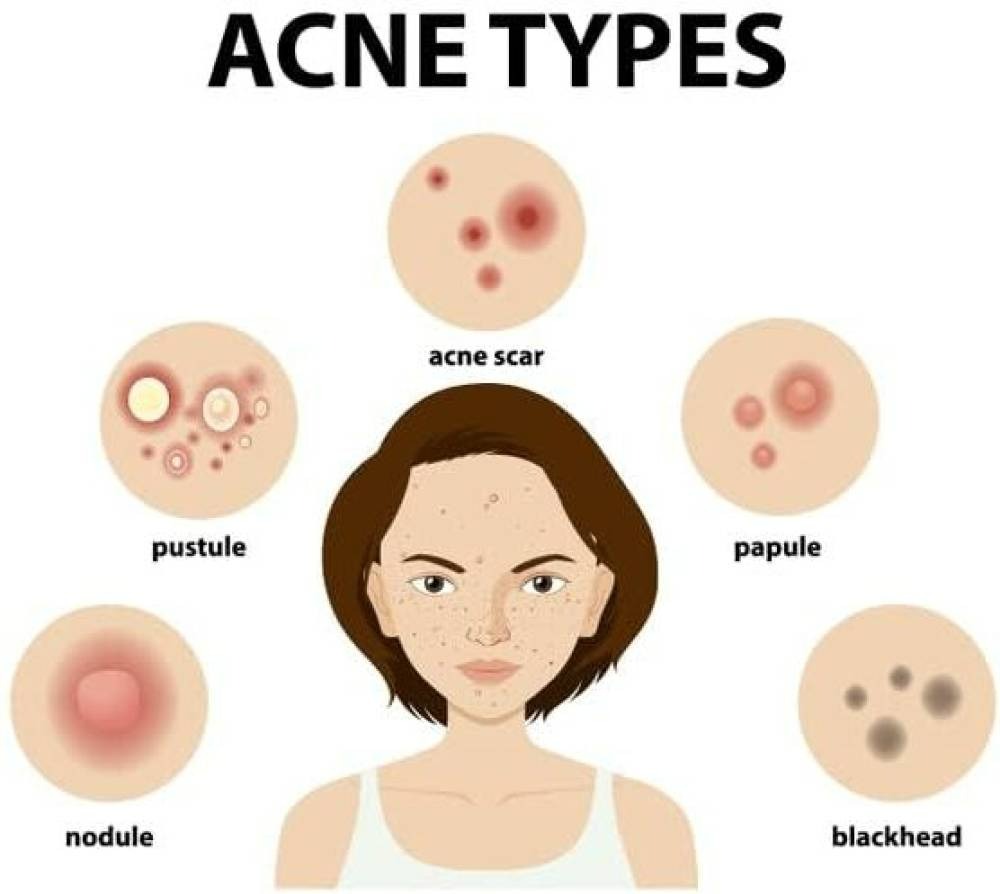 Ipca Acne UV Gel SPF 50