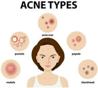 Ipca Acne UV Gel SPF 50