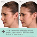 Lotus DermaBotanics Kojic Acid + Multi Berry Blemish-Free Face Wash, pH5.5, For Sensitive Skin