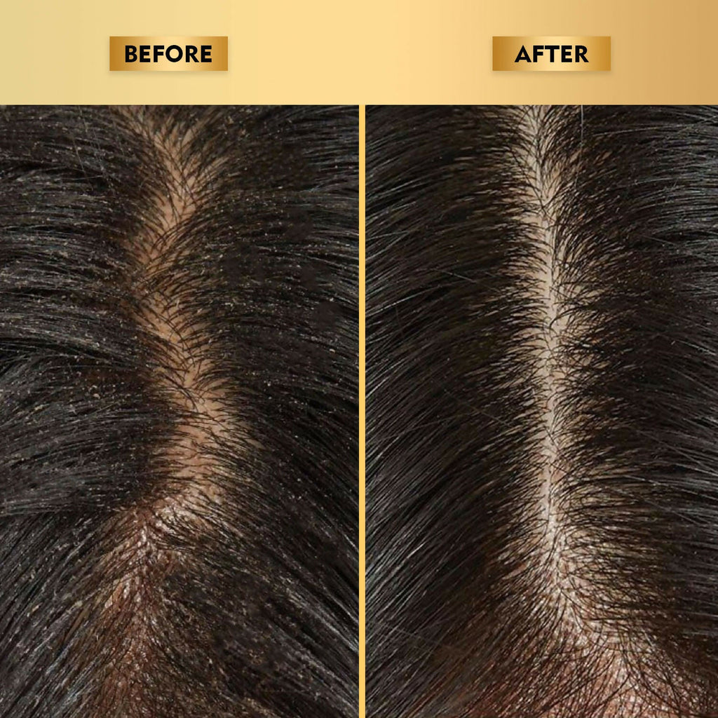 The Skin Story Anti-Dandruff Hair Scalp Serum