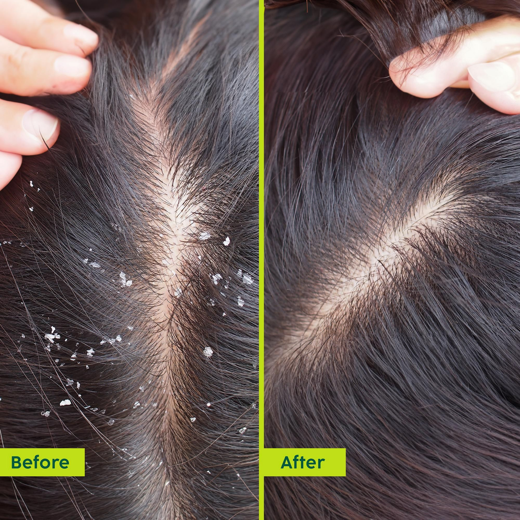 PLIX The Plant Fix Neem Anti-Dandruff Advanced Hair Serum For Reduce Dandruff & Inflammation