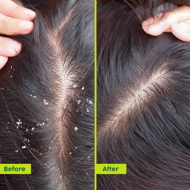 PLIX The Plant Fix Neem Anti-Dandruff Advanced Hair Serum For Reduce Dandruff & Inflammation Main Image