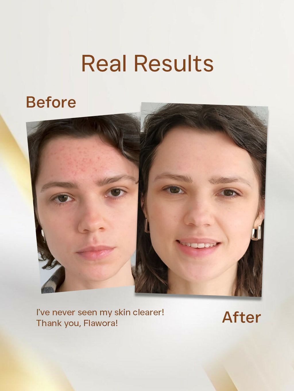 Flawora Anti Acne Serum to reduce Blackheads, Open Pore and D-Tan Lotion for Pigmentation & Tan Removal