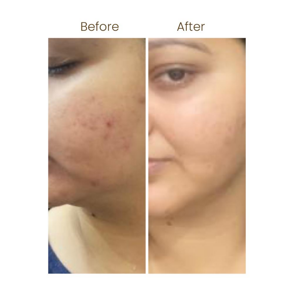 Personal Touch Aquarize Toner + Mist With Hyaluranic Acid For Intense Hydration All Skin Type